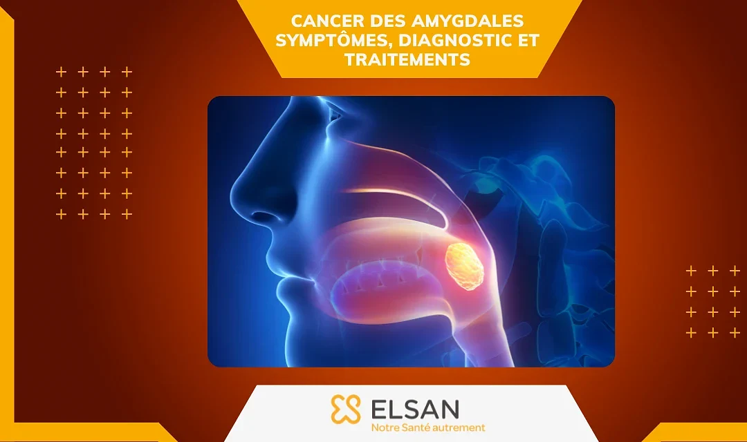 Cancer des amygdales : symptômes, diagnostic et traitements