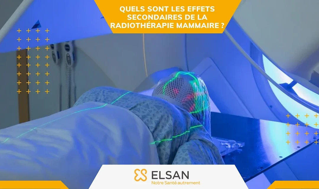 Quels sont les effets secondaires de la radiothérapie mammaire ?