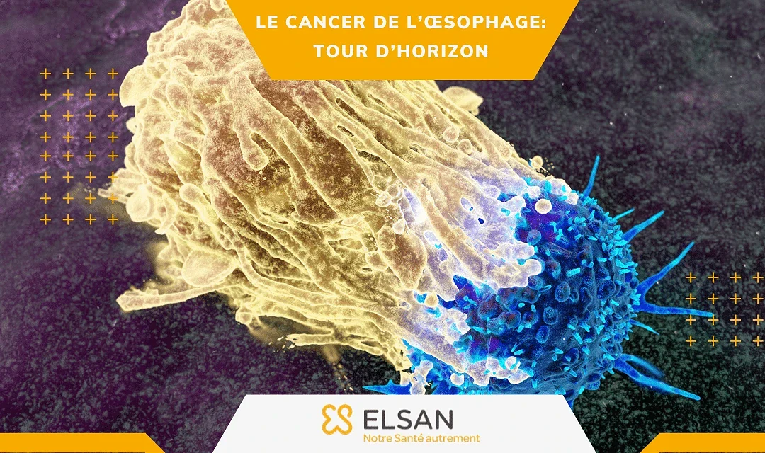 Le cancer de l’œsophage: symptômes, diagnostic et derniers traitements