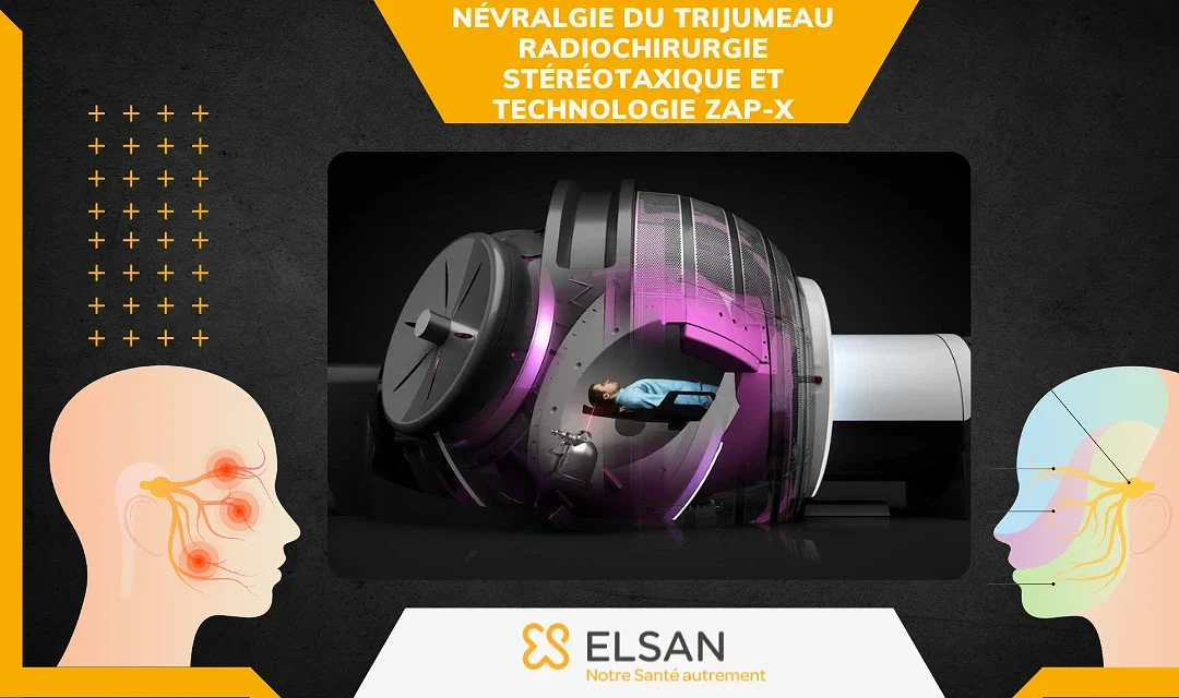 Névralgie du trijumeau : radiochirurgie stéréotaxique et technologie ZAP-X