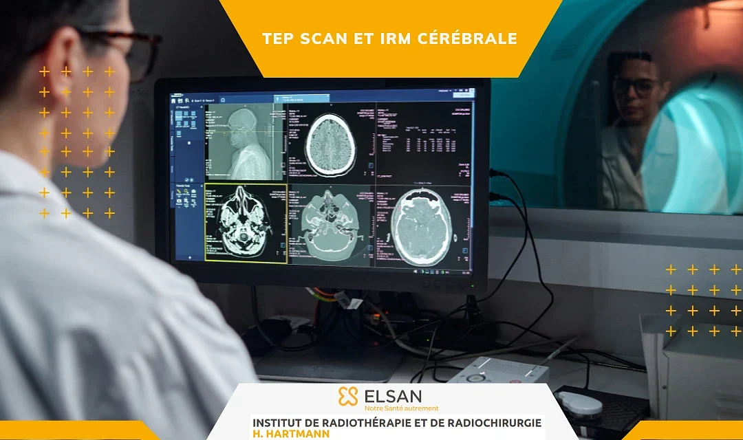 TEP Scan et IRM cérébrale – Bilan des métastases avant radiothérapie stéréotaxique