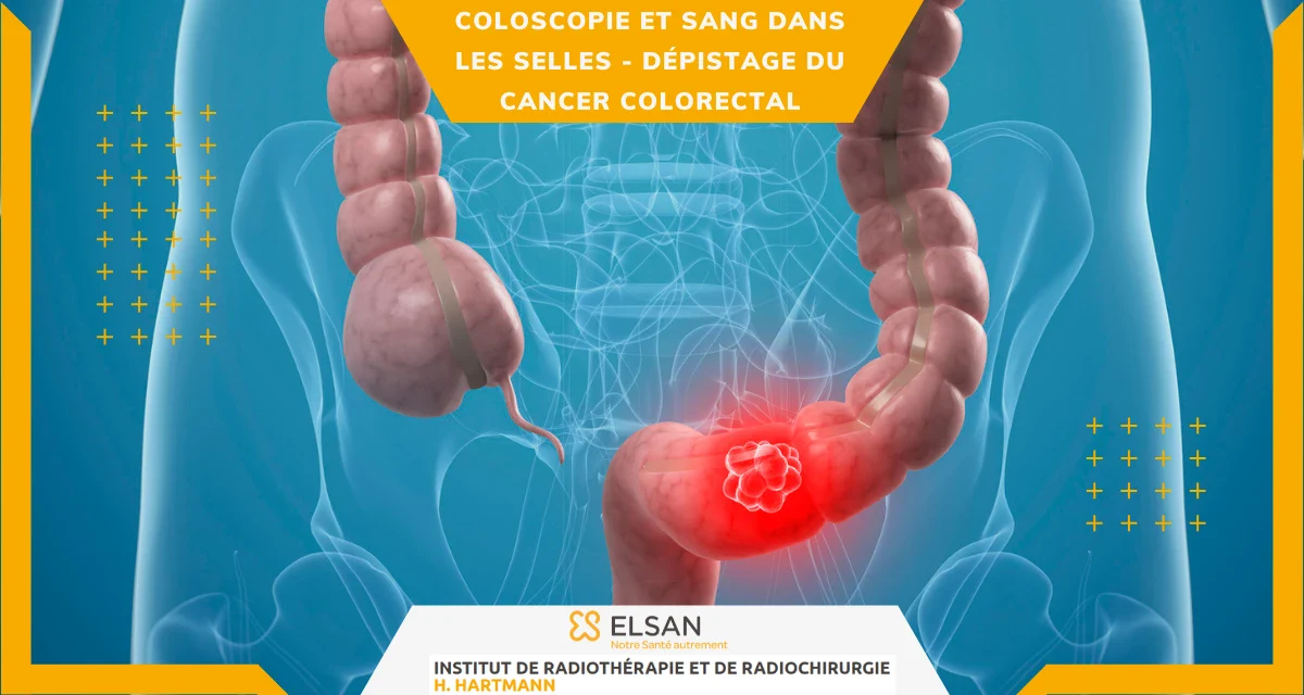 Coloscopie et sang dans les selles Dépistage du cancer colorectal Coloscopie et sang dans les selles Dépistage du cancer colorectal